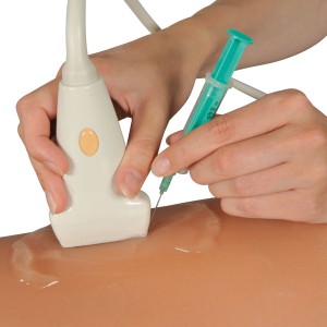 Ultrasound-guided Sclerotherapy